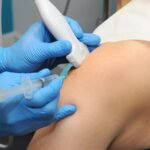 Effective Solutions for IT Band Syndrome: Ultrasound-Guided Injections by Sonoscope