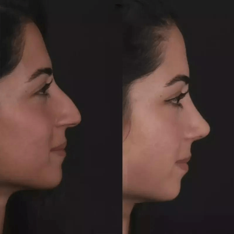 Decoding Rhinoplasty in Dubai: Your Complete Guide to the Procedure