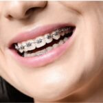 Never Too Late: The Journey of Adult Orthodontic Treatment