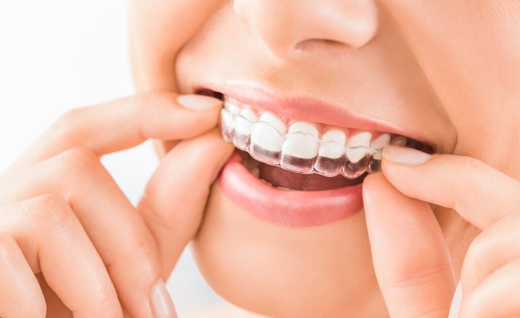 Straightening Smiles Seamlessly: The Magic of Invisalign