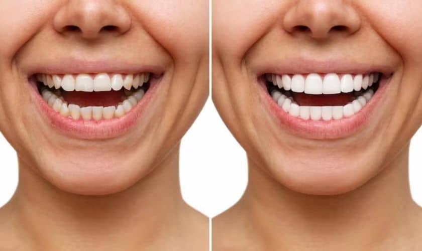 The Origins and Evolution of Dental Veneers