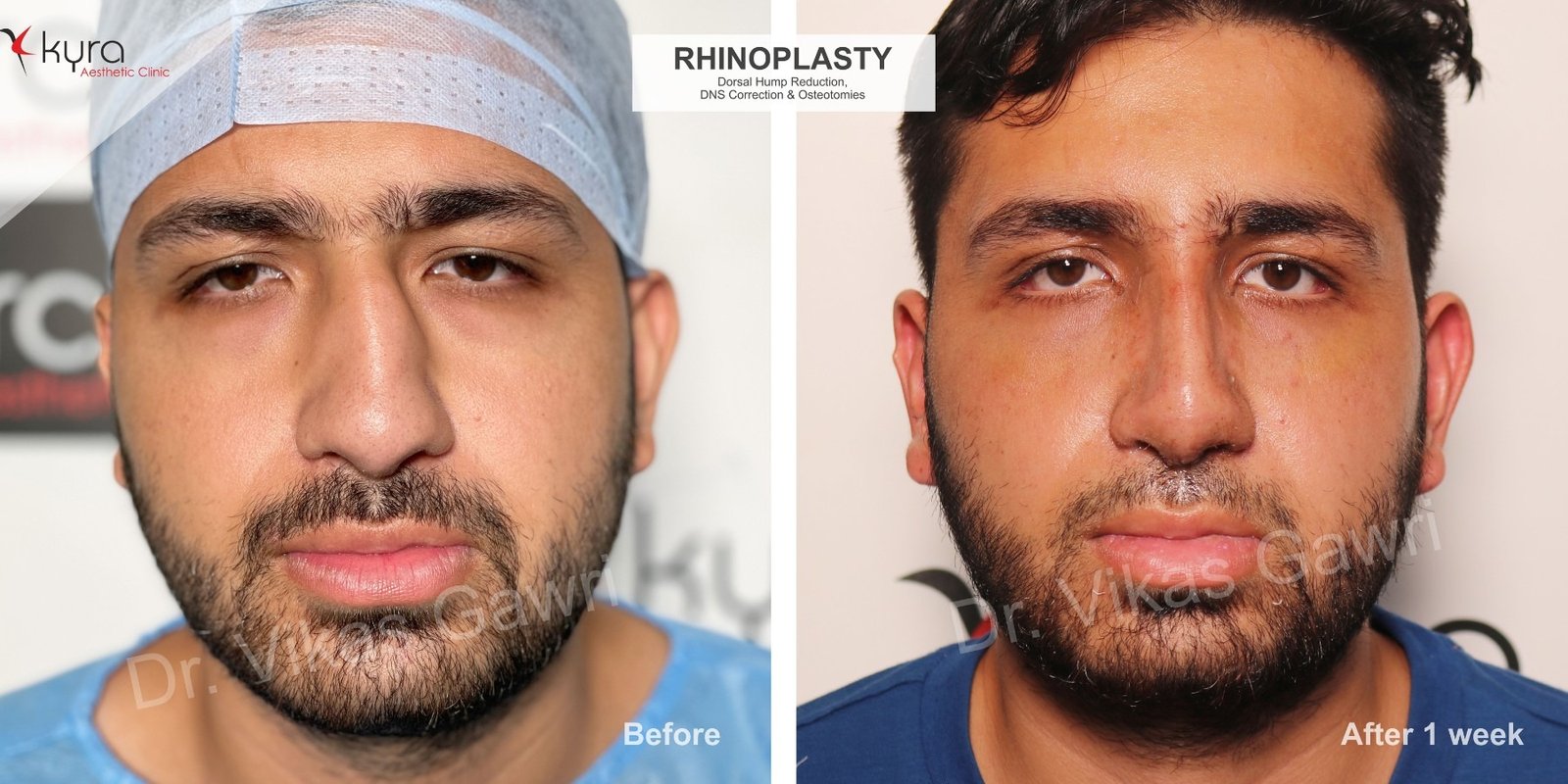 rhinoplasty dorsal hump reduction kyra clinic patient3 front1 1800x900 1