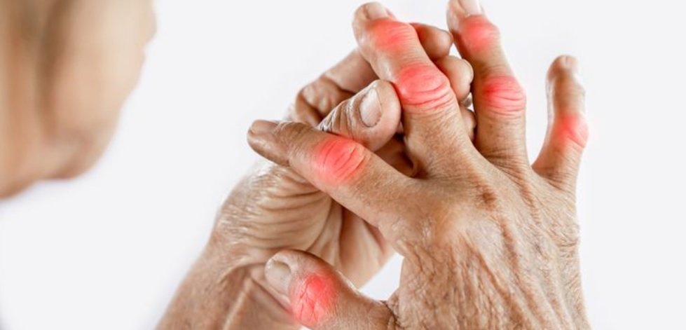 Rheumatoid Arthritis