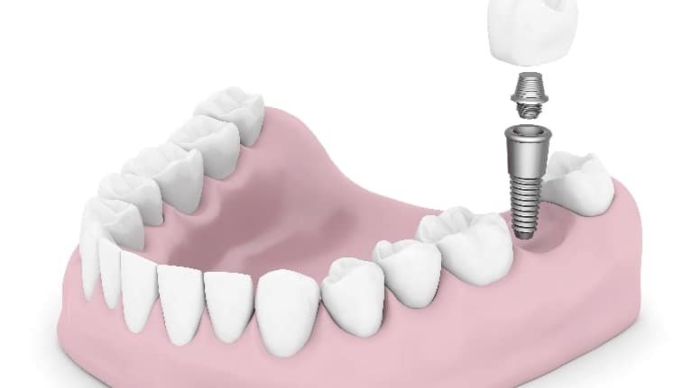 implant costs crawfordville fl