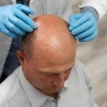 The Importance of Experienced Surgeons for the Best Hair Transplant in Jaipur