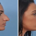 Rhinoplasty in Dubai: Why It’s the Best Place for Nose Jobs