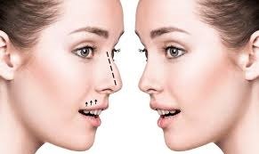 Rhinoplasty