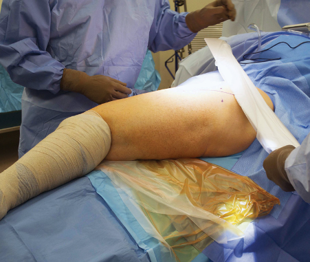 hip replacement surgery