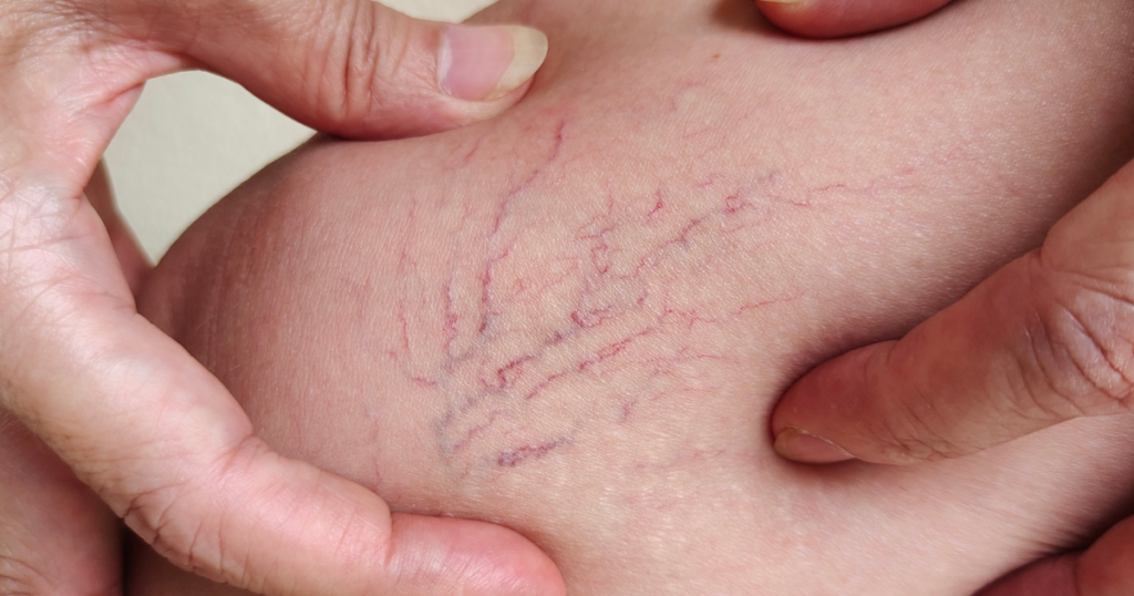 Vein Care Center Mokena