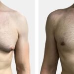 Understanding the Difference Between Gynecomastia and Chest Fat