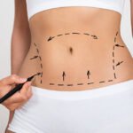 How to Choose the Best Liposuction Surgery in Dubai