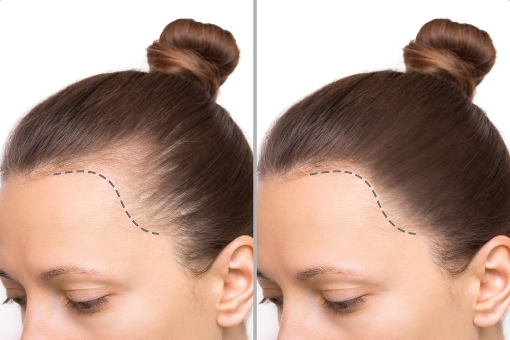 long hair transplant cost in India