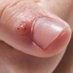 The Future of Dermatology: Innovative Wart Removal Treatments