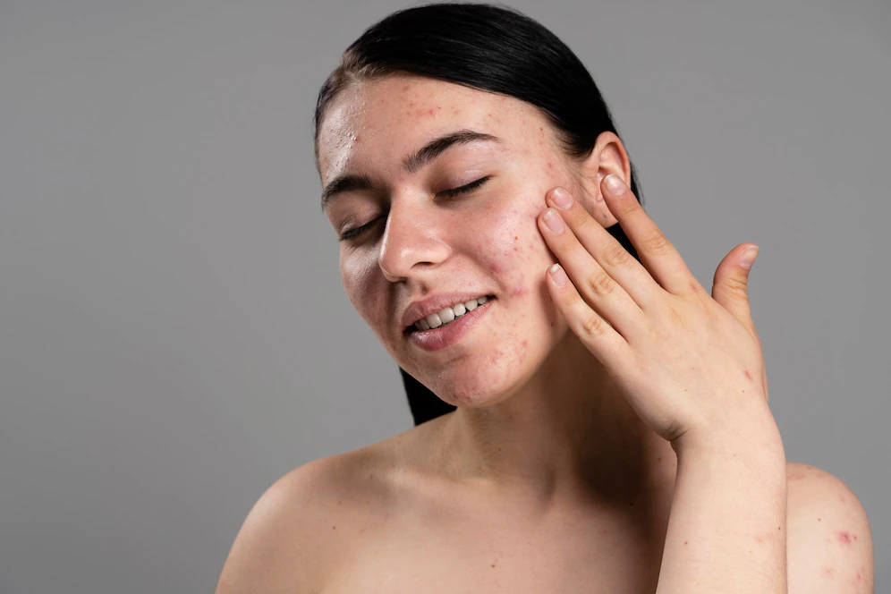 Acne Treatment in Abu Dhabi: Clear Your Skin for Good