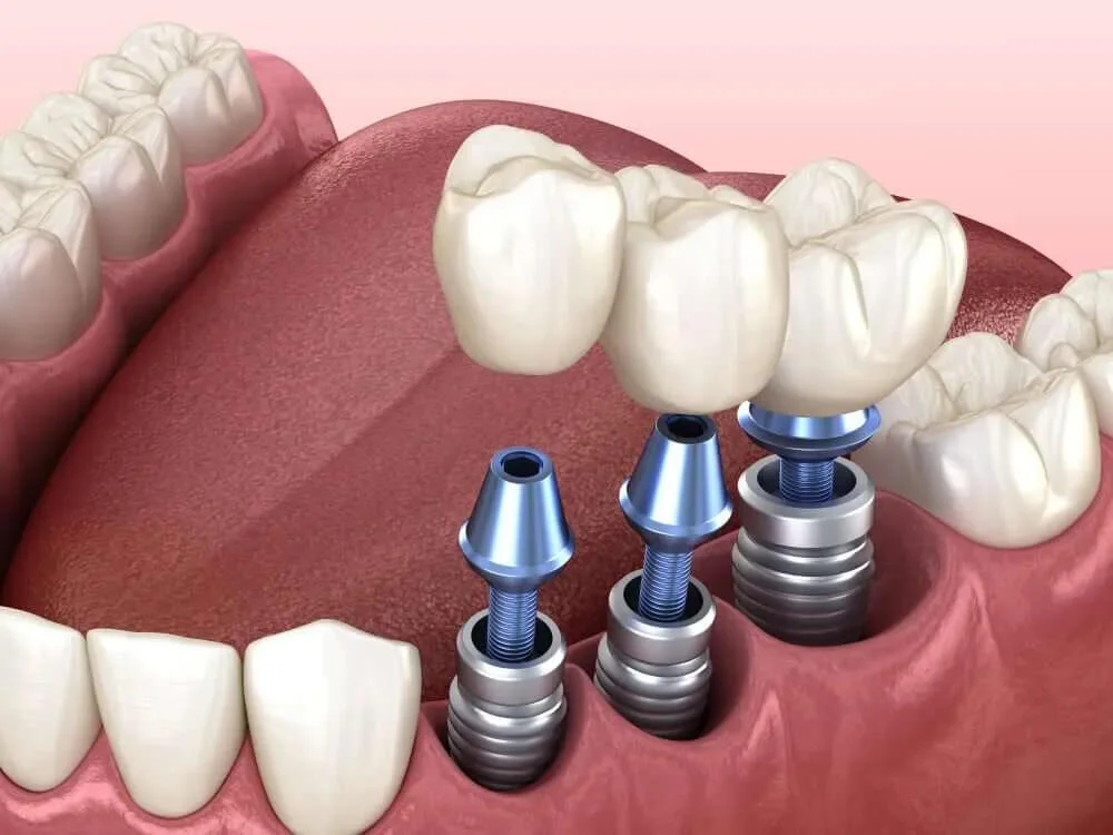 dental Implant Aberdeen