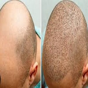 Hair Transplant in Riyadh