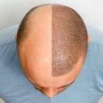 Discover a New You with Hair Transplant Solutions in Riyadh