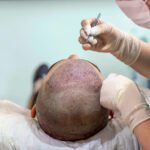 Hair Transplant: A Permanent and Natural-Looking Solution for Hair Loss