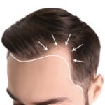 Why Hair Transplant Prices Vary from Clinic to Clinic