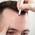 The Role of Technology in Hair Transplant Pricing in Dubai