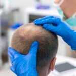 Hair Transplant Cost Breakdown in Dubai: 2024 Insights