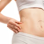 Lipoabdominoplasty: Combining Tummy Tuck and Liposuction