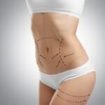 What to Expect During Liposuction Surgery in Dubai