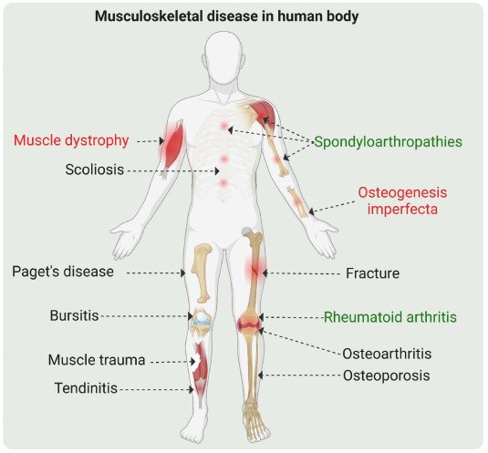 Musculoskeletal Disorders in human