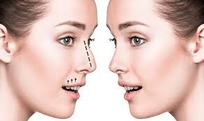 Rhinoplasty in Dubai