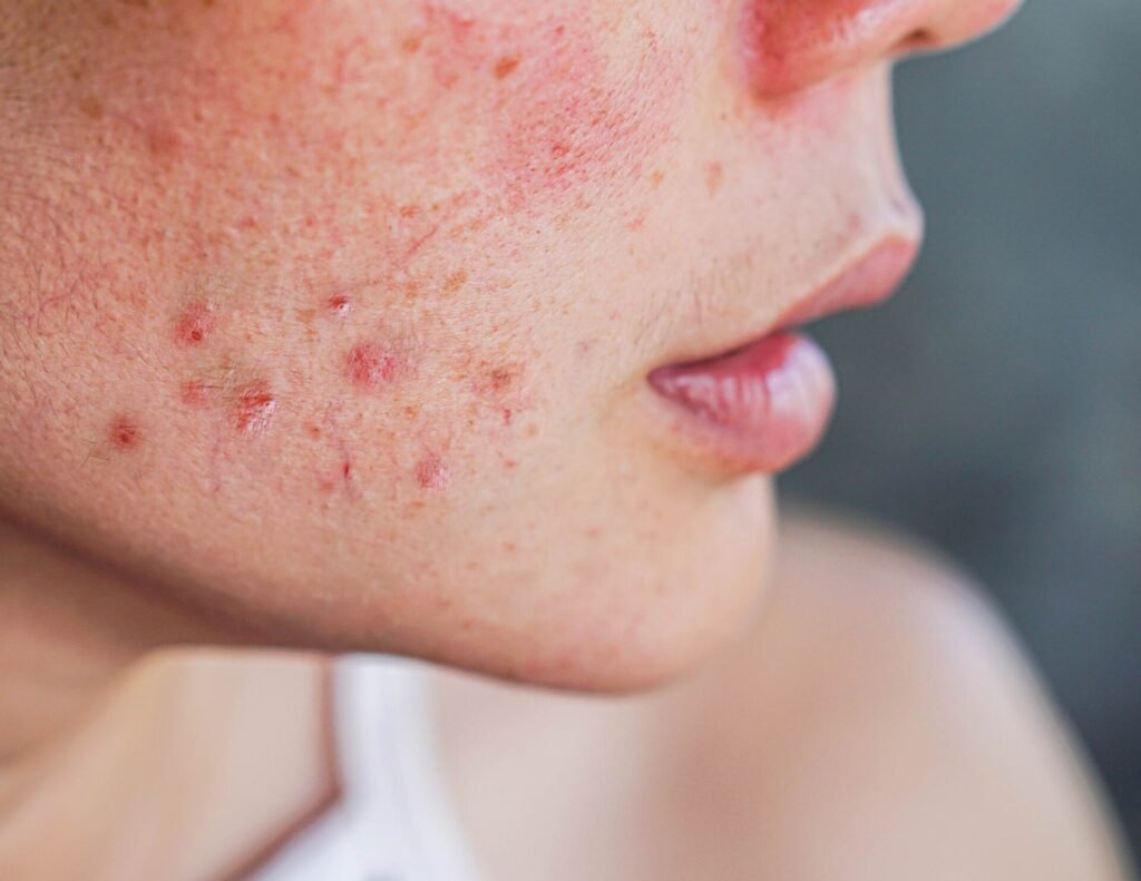 Acne and Congested Skin