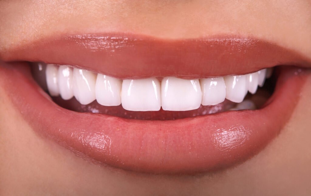 dental veneers in riuyadh