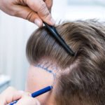 The Cost of Beauty: Hair Restoration Prices in Dubai