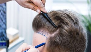 Hair transplant cost in Dubai