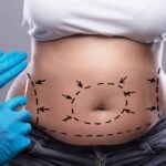 Exploring Minimally Invasive Techniques from the Best Tummy Tuck Surgeons in Dubai