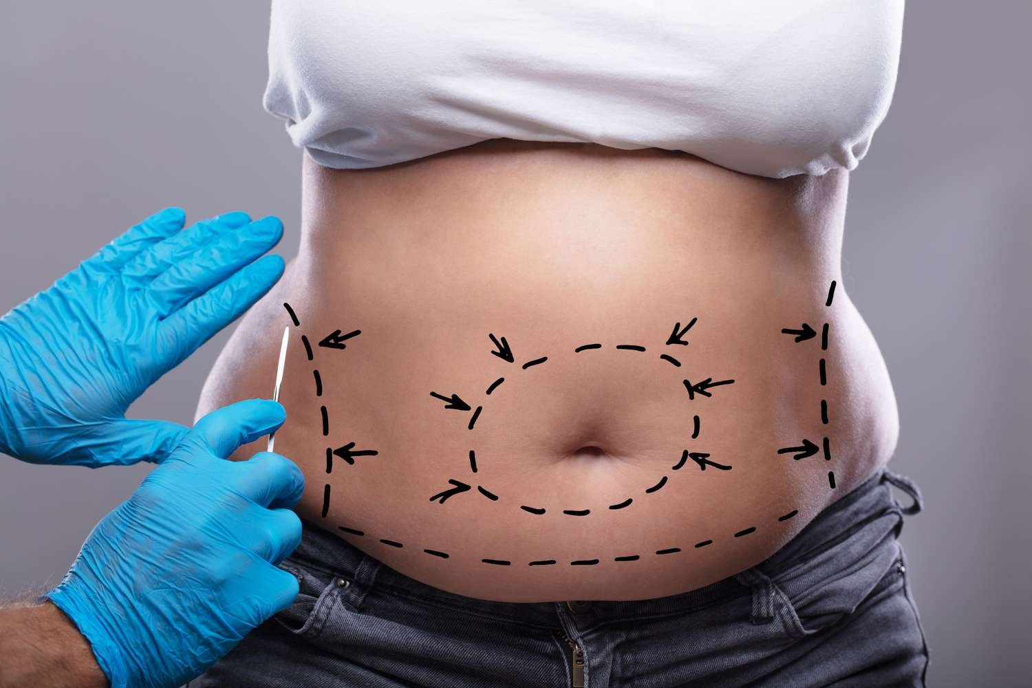 Tummy Tuck Surgery In Dubai