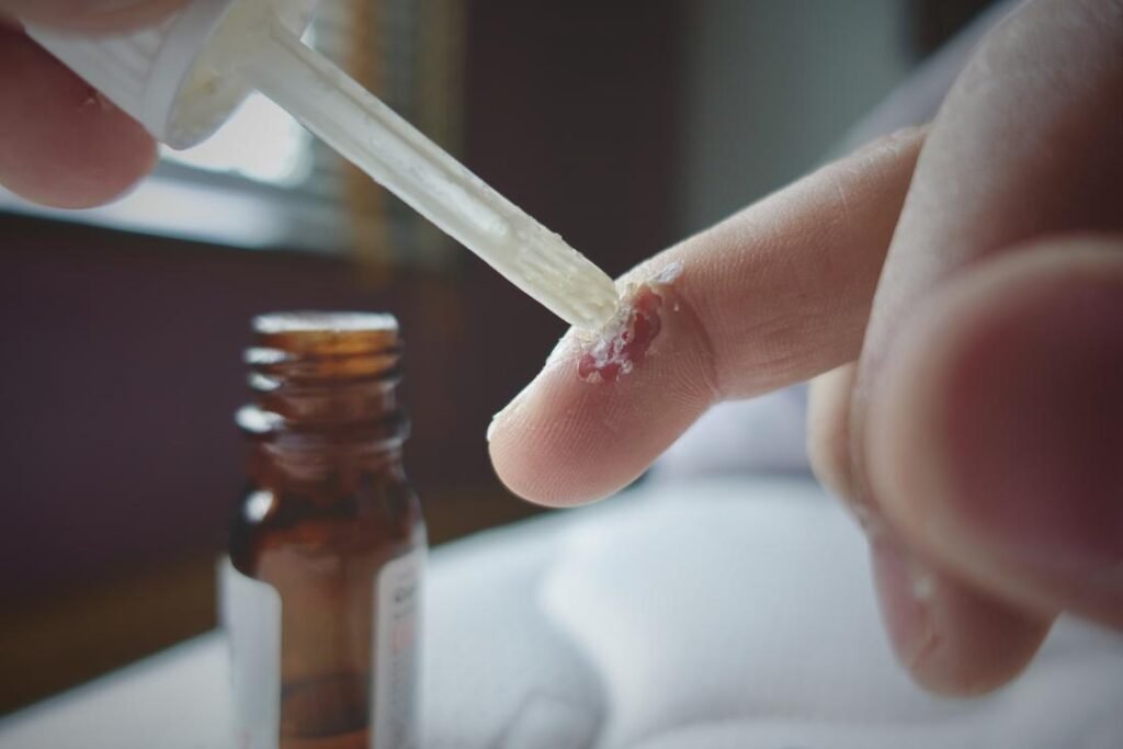 wart removal treatment