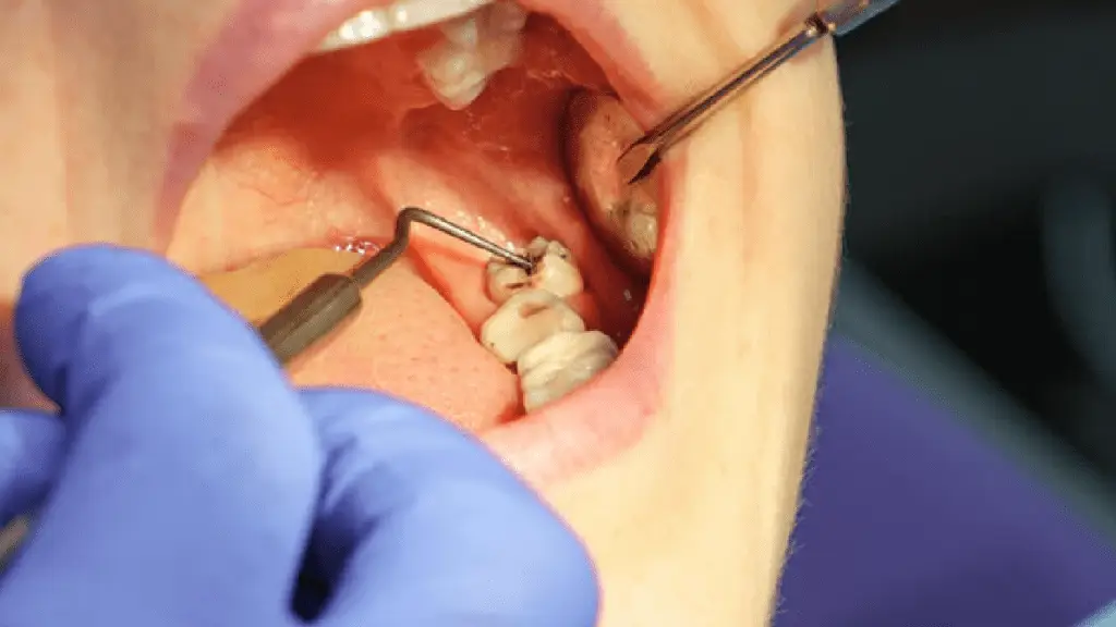 wisdom tooth extraction in etobicoke