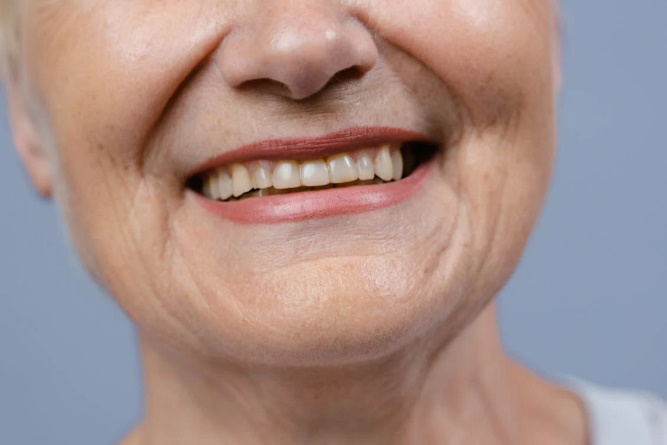 Close-up of teeth showing effects of grinding