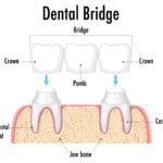 Top Reasons to Consider a Dental Bridge for a Healthy and Perfect Smile