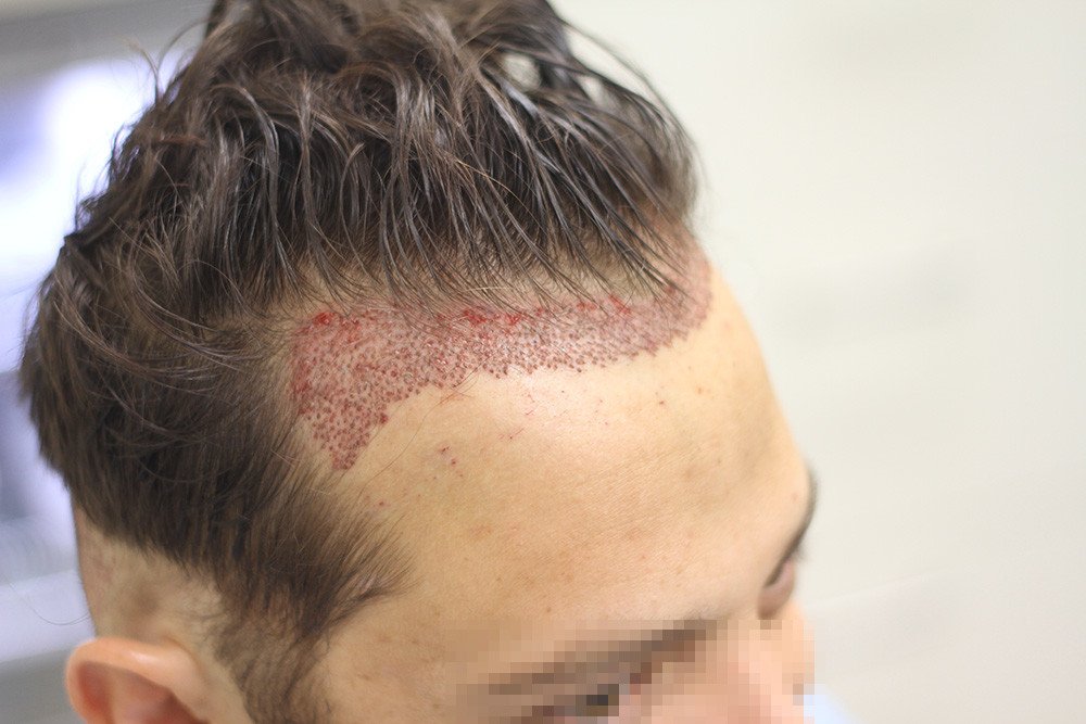 Hair Transplant Cost in Dubai