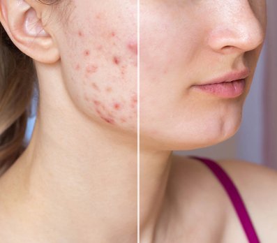 How to Get Rid of Acne in Dubai Effective Treatments for Every Skin Type