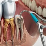 Choosing the Right Dentist for Root Canal Therapy in West Edmonton