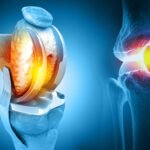 What to Expect During Joint Replacement Treatment in Lahore?