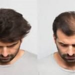 Natural Hair Growth Guaranteed with Transplants in Dubai