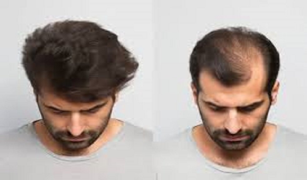 Hair Transplant in Dubai