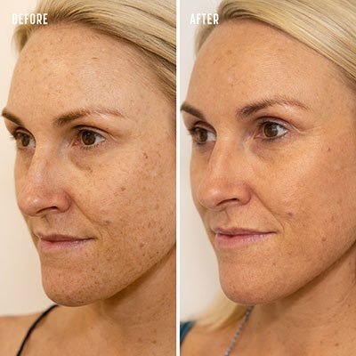 Laser Hyperpigmentation Removal