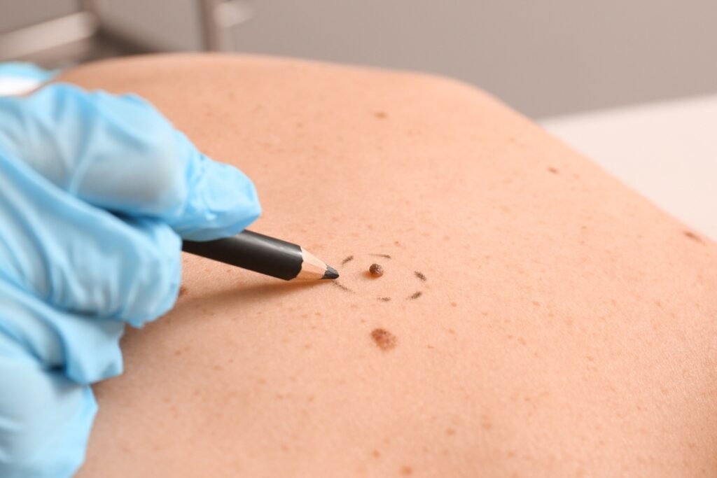 Mole removal in Dubai