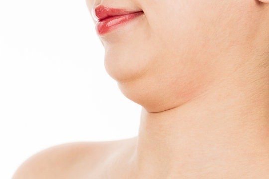 Chin liposuction Dubai