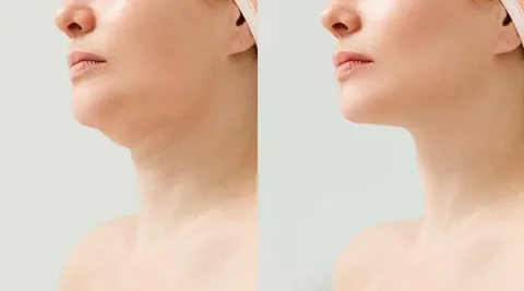 Chin liposuction Dubai