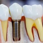 Your Short and Essential Guide to Dental Implants in Osseo